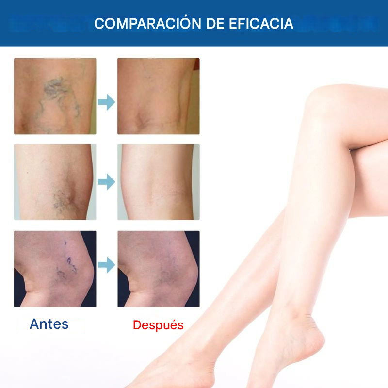 Balanlogy - Solución en aerosol para venas varicosas
