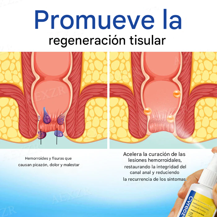 50 % de descuento en aerosol Cvreoz® Herbal para hemorroides de acción rápida