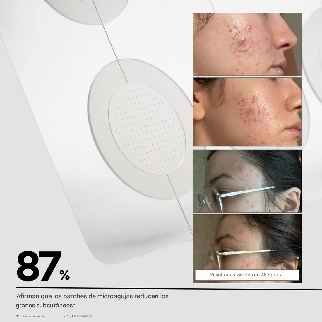Parches de microagujas para detener las manchas