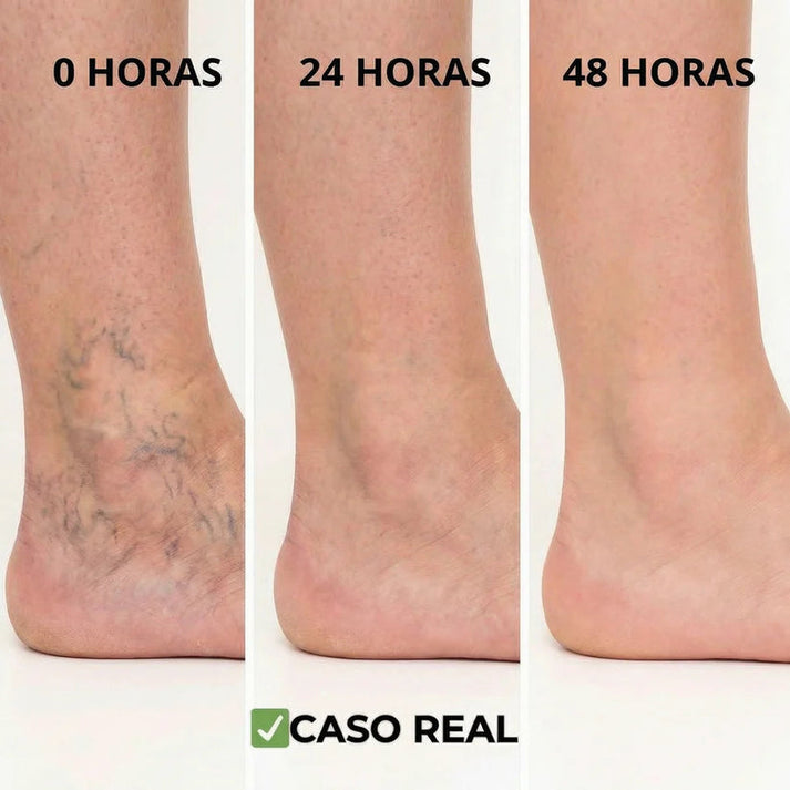 Paga 1 Lleva 3 (36unds) Parches Naturales Para Varices Y Para Las Piernas Cansadas - VeinPatch™