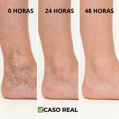 Paga 1 Lleva 3 (36unds) Parches Naturales Para Varices Y Para Las Piernas Cansadas - VeinPatch™