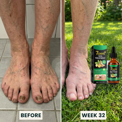 Suero para el tratamiento de hongos en las uñas 🍃