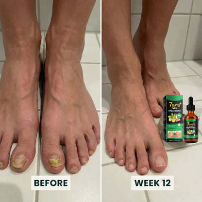 Suero para el tratamiento de hongos en las uñas 🍃