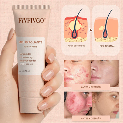 Gel exfoliante purificante Fivfivgo® para acantosis nigricans, exfoliación, manchas oscuras, verrugas y eccema.