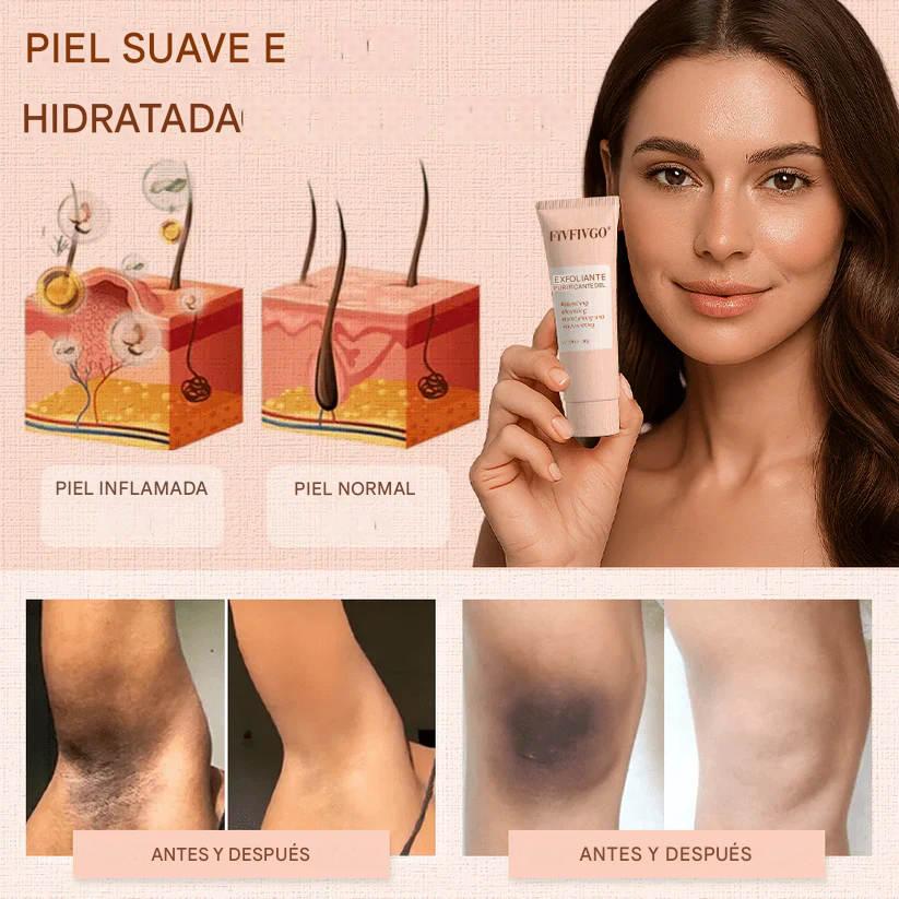 Gel exfoliante purificante Fivfivgo® para acantosis nigricans, exfoliación, manchas oscuras, verrugas y eccema.