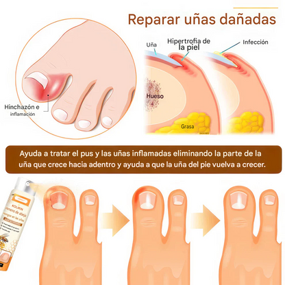 UNPREE™ Spray para hongos en las uñas con veneno de abeja Kolirin 💥
