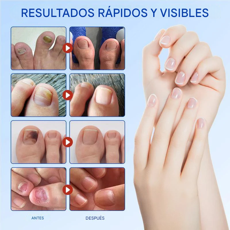 Parches para la renovación de uñas durante la noche