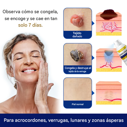 ChillErase✨👩‍⚕️ Spray removedor de bultos