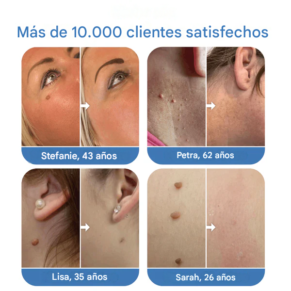 Libre de verrugas   -   El   Acrocordones   agente de mudanzas (40 pcs reutilizables)