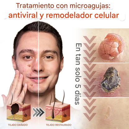 SkinPrik™ – Parche Botánico Anti-Verrugas (9 UND)