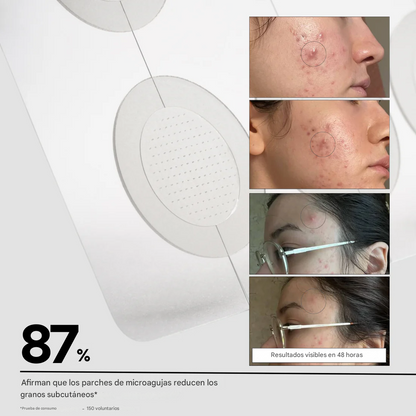 Parches de microagujas para detener las manchas